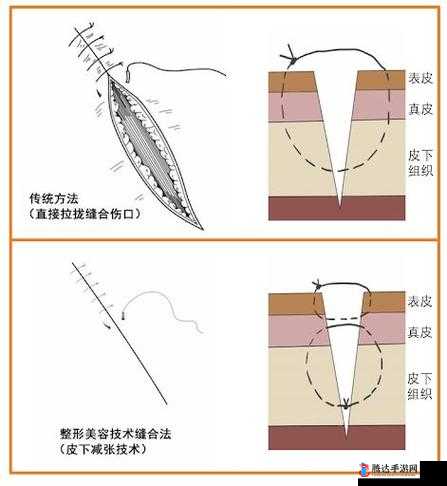竹板打肿臂缝合不上:探究这一离奇事件的真相与启示