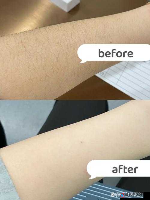 未满十八岁可以激光脱毛吗女生：探索青春期脱毛的可行性