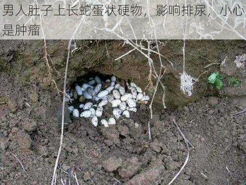 男人肚子上长蛇蛋状硬物，影响排尿，小心是肿瘤